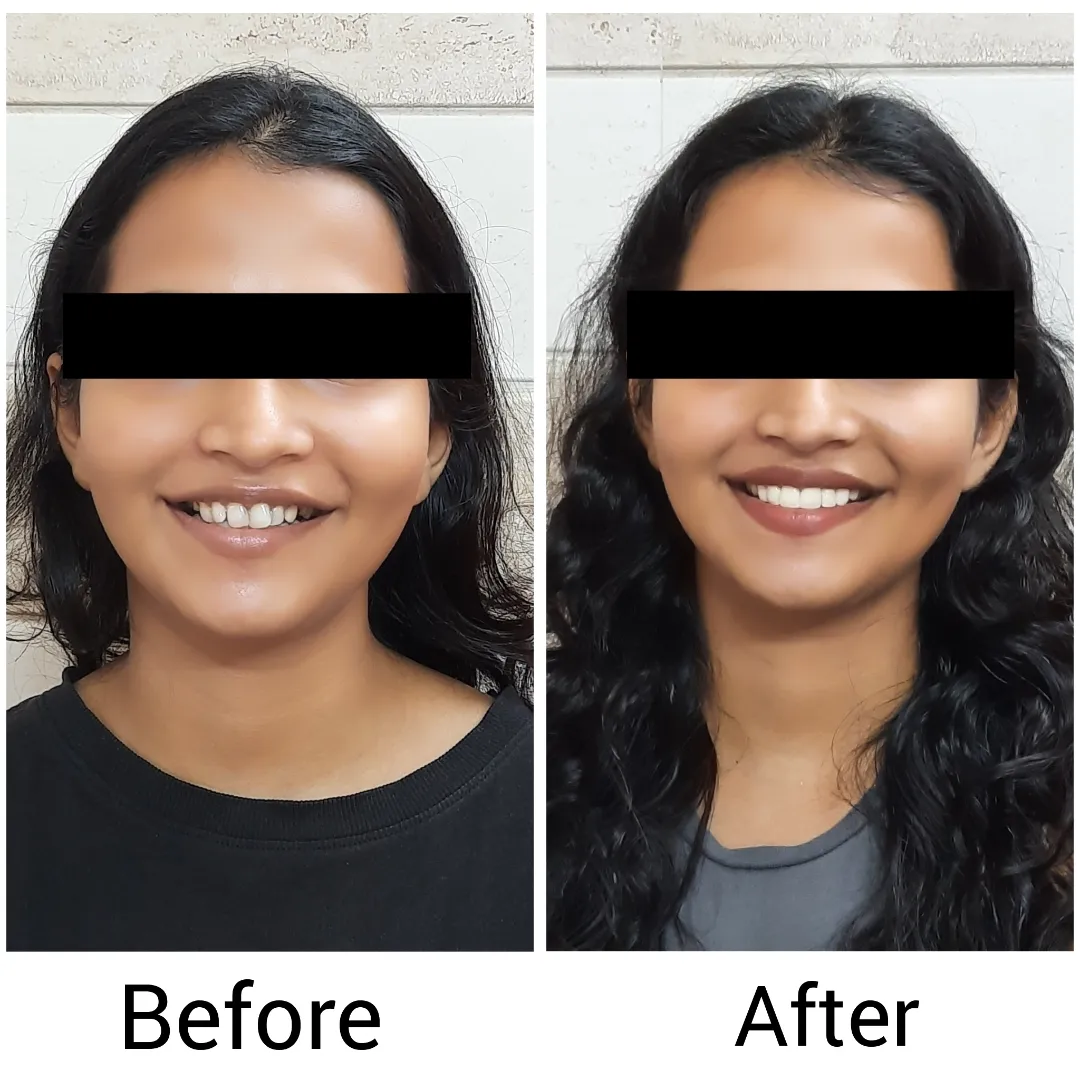 Before and After Veneers