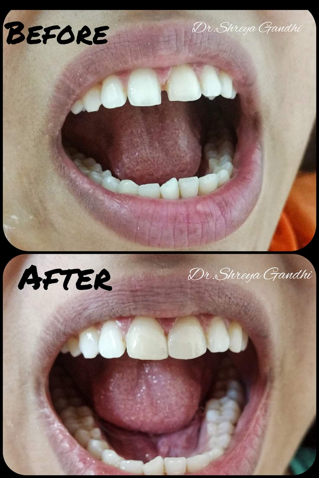Before and After Dental Treatment