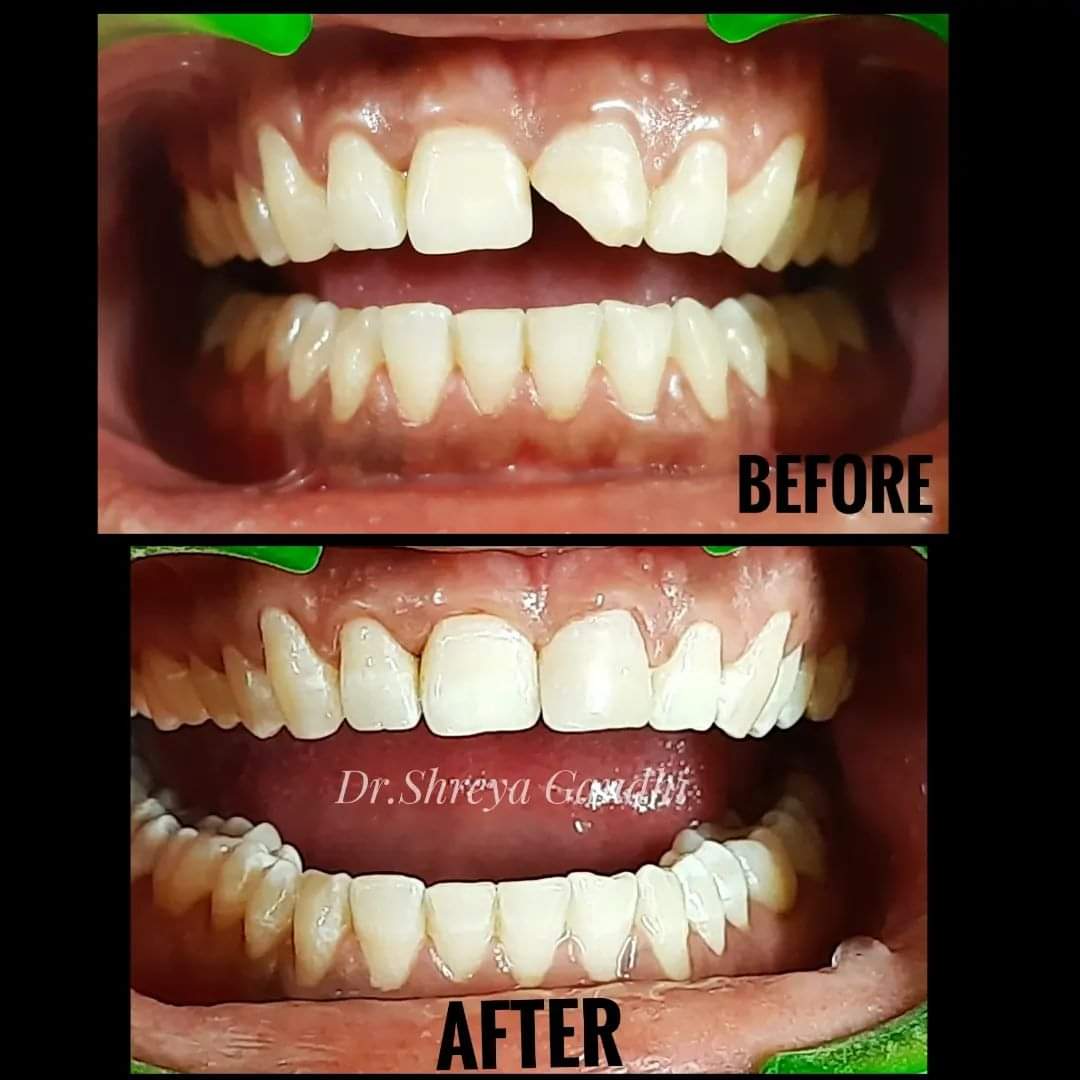 Before and After Dental Treatment