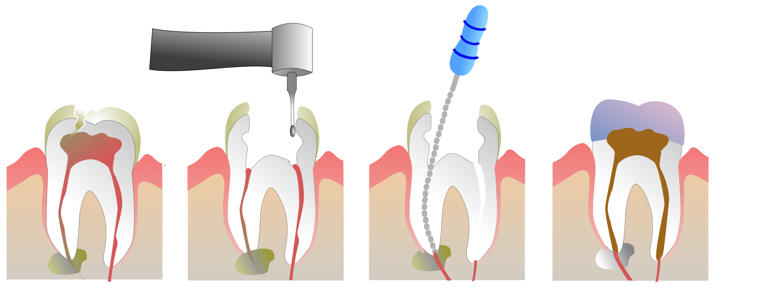 Advanced root canal treatment at Apex Dental Clinic Chembur