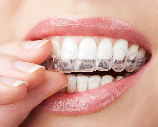 Clear aligners treatment at Apex Dental Clinic Chembur